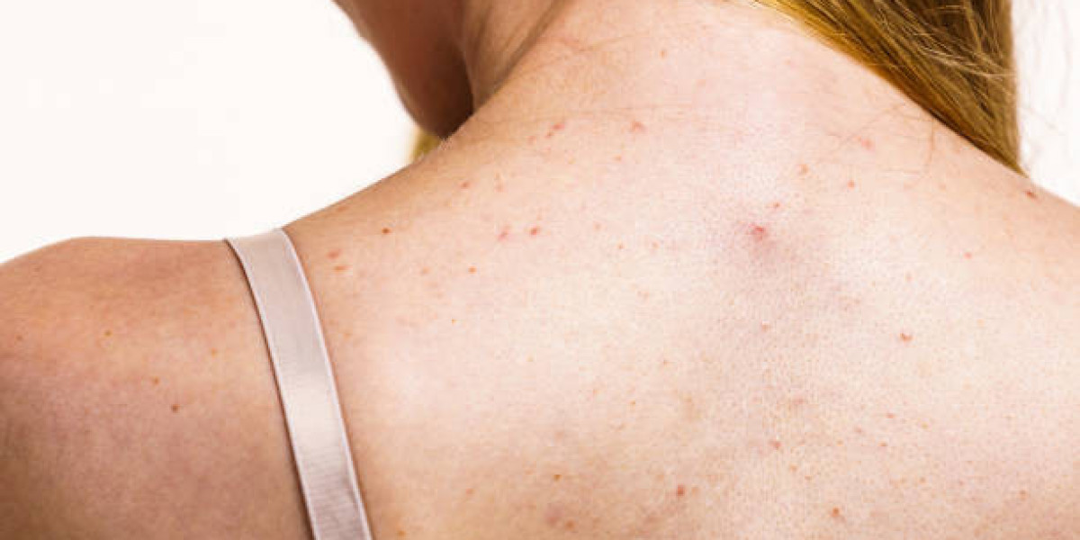 كيف تتجنب ندبات حب الشباب على الظهر؟