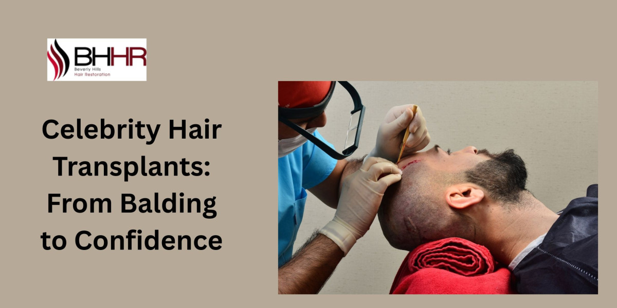 Celebrity Hair Transplants: From Balding to Confidence