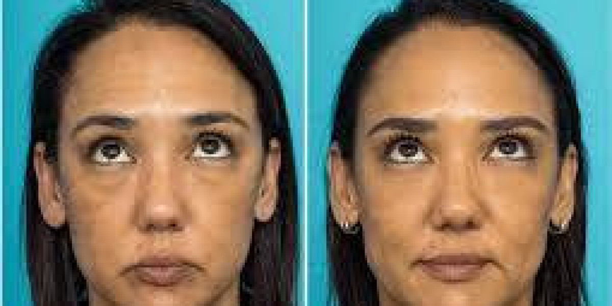 How Droopy Eyel⁠i‌ds Affect You‍r Visio⁠n—And How Surger‌y Can Help