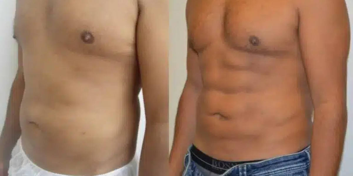 Common Myths About Vaser 4D Liposuction in Duba