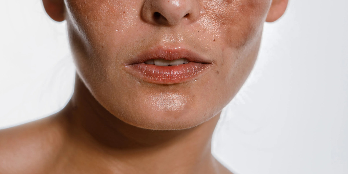 Why Do People Choose Pigmentation Treatment Dubai