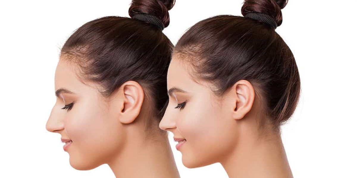 Rhinoplasty what makes it the ultimate nose glow upgrade now?