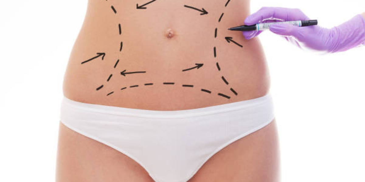 Liposuction Offers for a More Defined and Contoured Shape