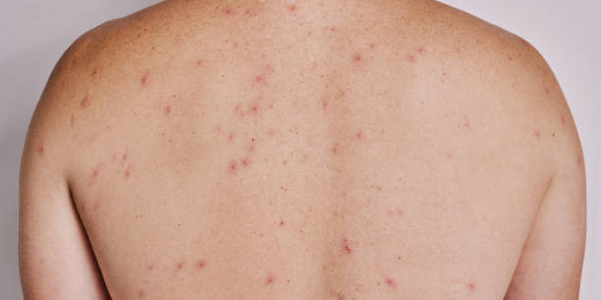 Natural Remedies for Back Acne Recommended in Riyadh
