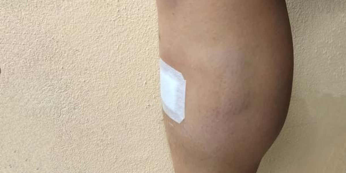 Lifestyle and Dietary Tips for Lipedema Management in Riyadh
