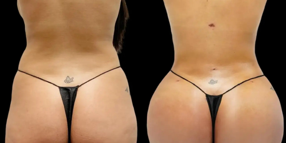 Fat transfer in Dubai: How Patient Expectations Affect Satisfaction
