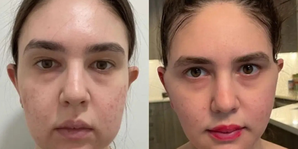 Complete Buccal fat removal in Dubai Guide