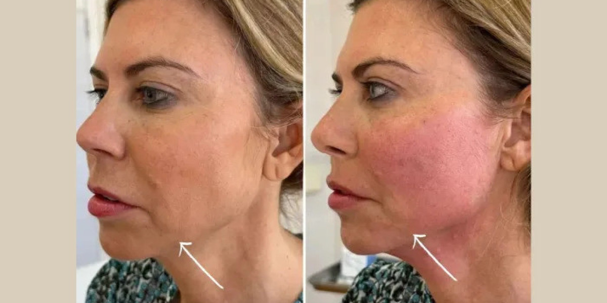 Best Plastic Surgeons in dubai for Subtle Endolift Facial Transformation