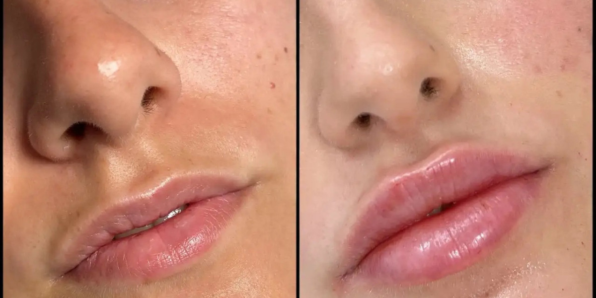 Best Plastic Surgeons in dubai for Full-Face Dermal Fillers