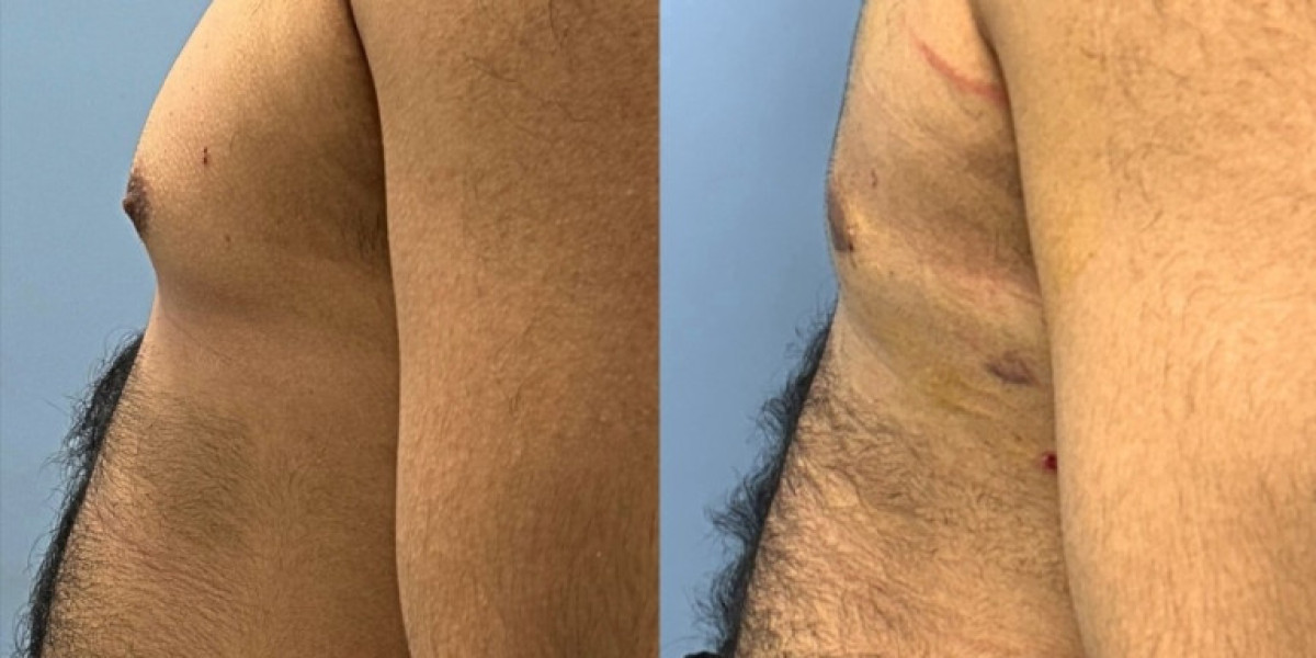 How Much Does Men Breast Tissue Removal Cost?
