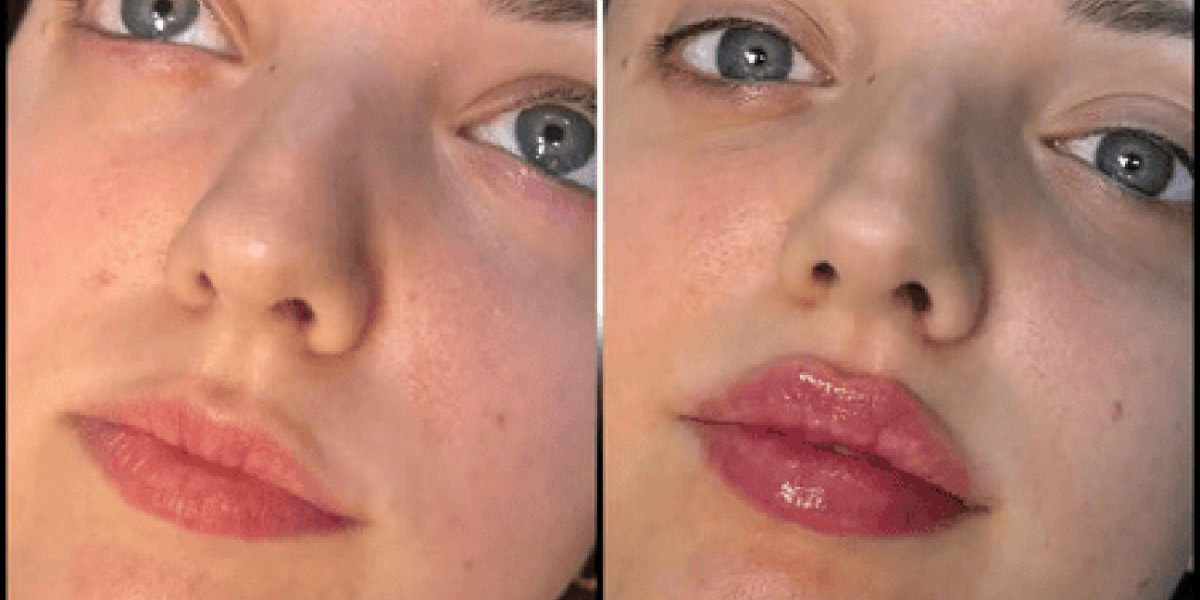 Best Plastic Surgeons in dubai: Beauty Enhancement with Fillers
