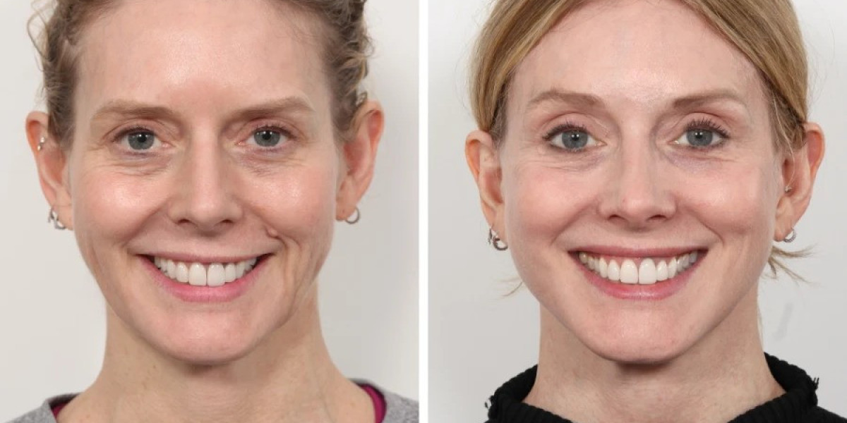 Thread Lift Treatment in Dubai for Facial Contouring