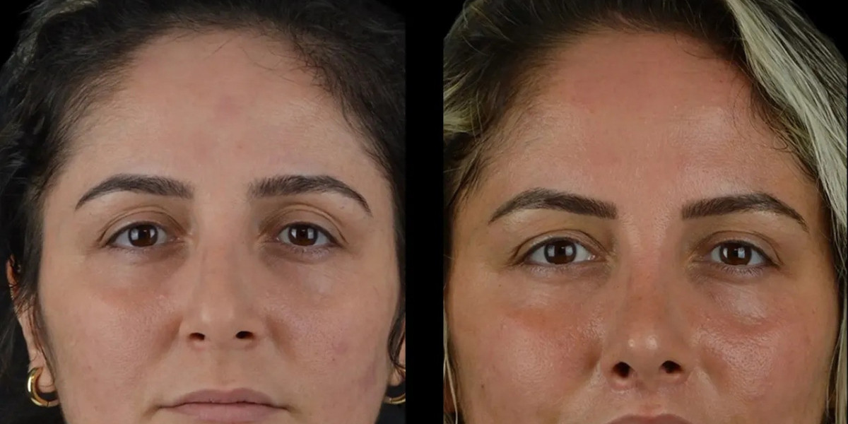 Trusted Cheek Fillers Specialists Best Plastic Surgeons in Dubai