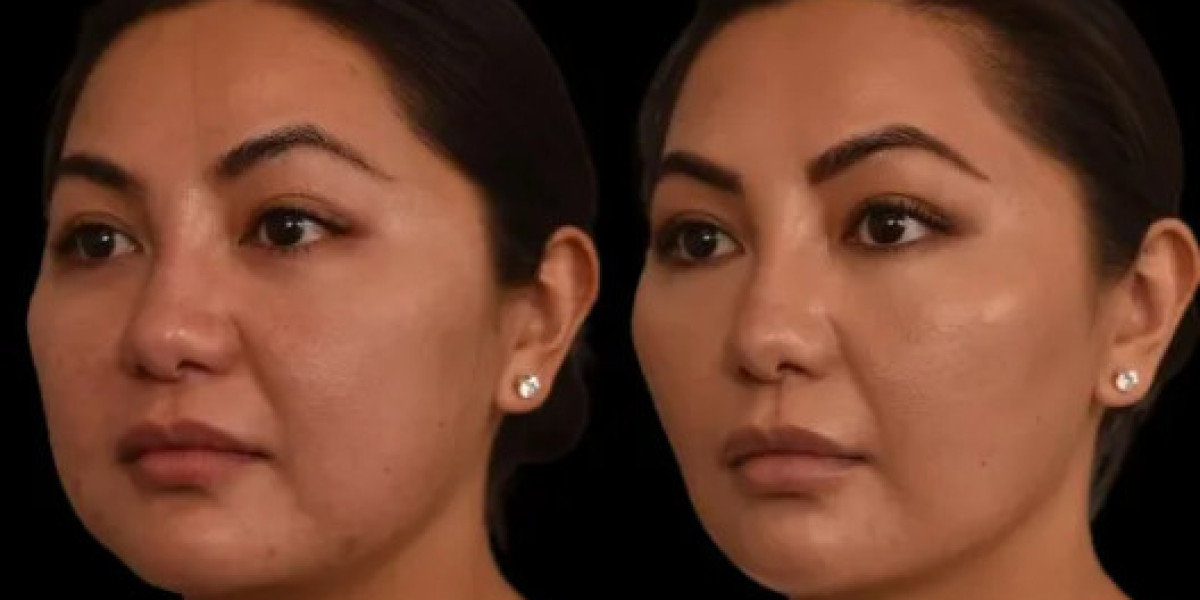 Double chin removal in Dubai Face Contouring