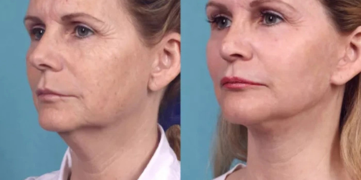 Best Plastic Surgeons in dubai for Chemical Peels and Enhancing Natural Skin Appearance