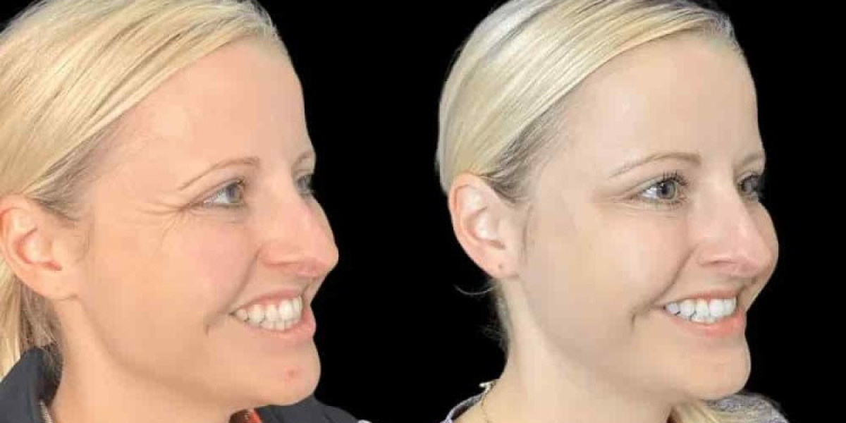 Best Aesthetic Clinic in Dubai for Botox: A Complete Guide for New Patients