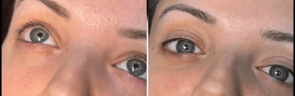 dermal fillers Cover Image