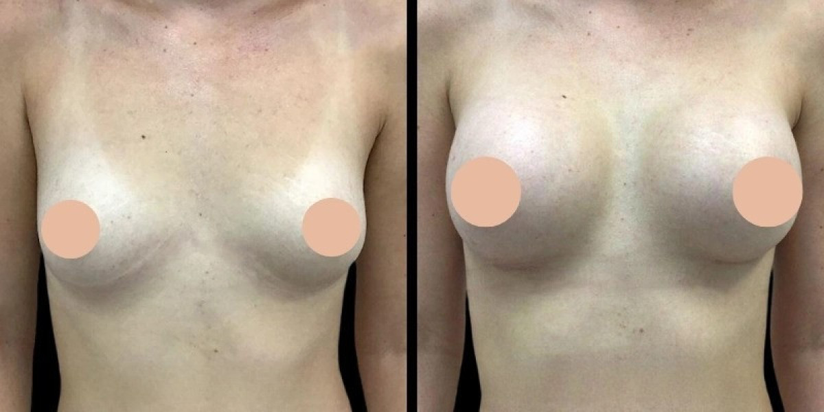 Breast Augmentation in Dubai: Preparing for Surgery and Recovery
