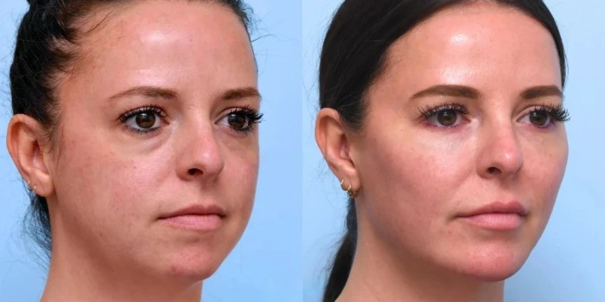 Best Plastic Surgeons in Dubai: Premium Facial Thread Lift Techniques