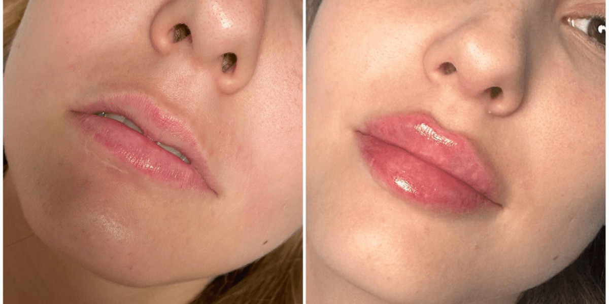 Juvederm Confidence Best Aesthetic Clinic in Dubai
