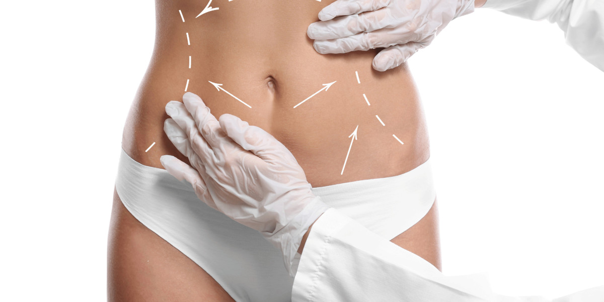 Liposuction for the Calves: Candidacy and Expectations