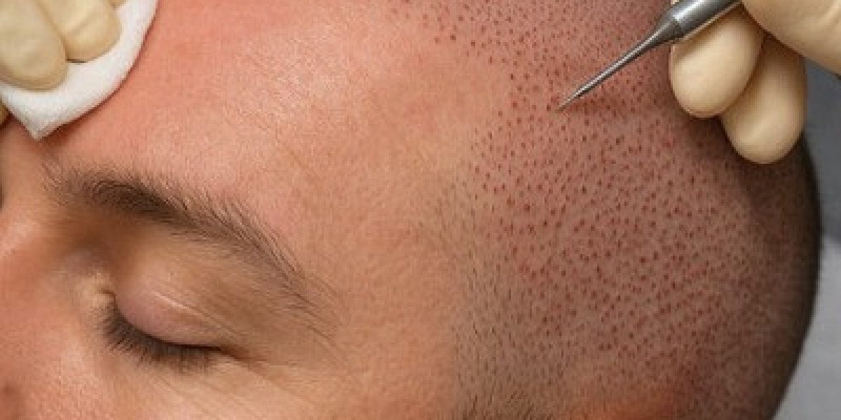 FUE Hair Transplant: Understanding the Benefits and Results