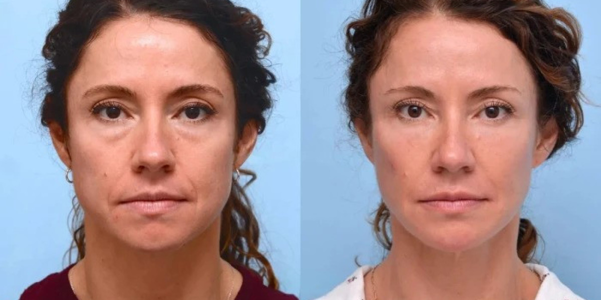 Thread Lift in Dubai: Minimally Invasive Enhancement for Elegant Beauty
