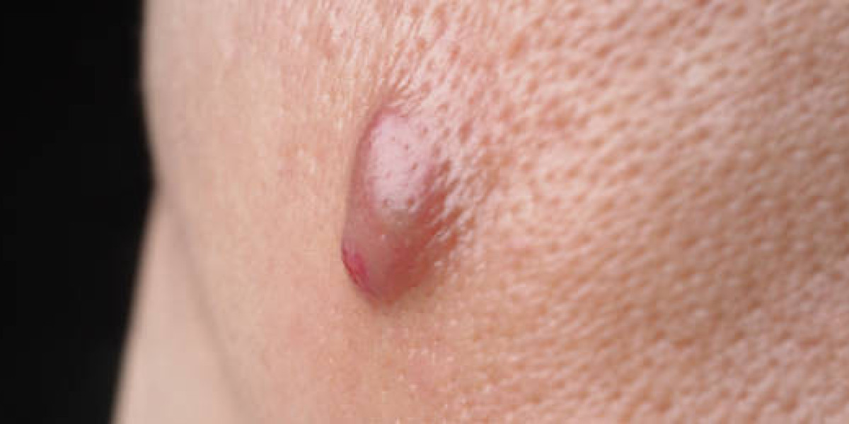 Sebaceous Cyst Removal Cost in Riyadh: What to Know