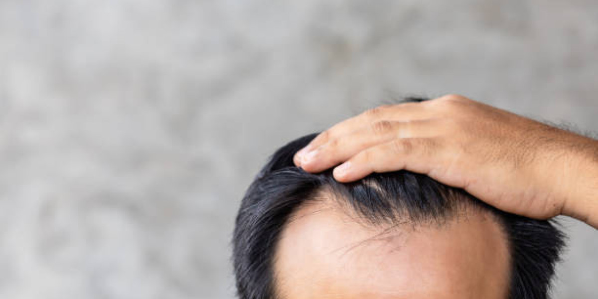 What Should You Do Before a PRP Hair Treatment Session?