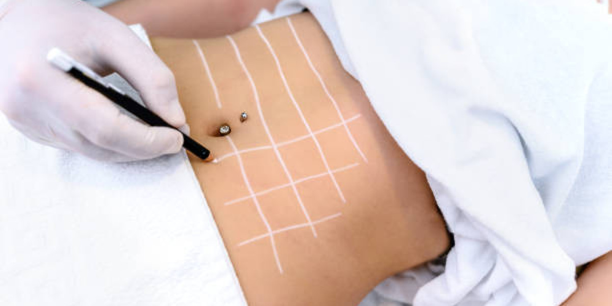 Aftercare Tips Following Fat Melting Injection Treatments