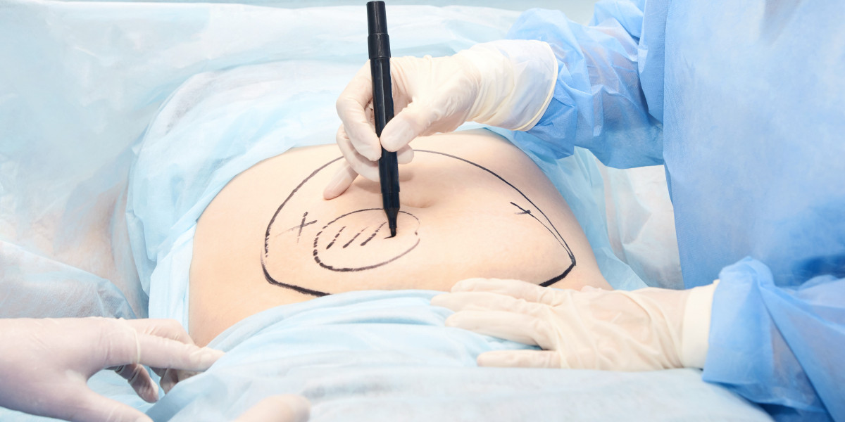 Ultrasound-Assisted Liposuction: Uses, Benefits, and Risks