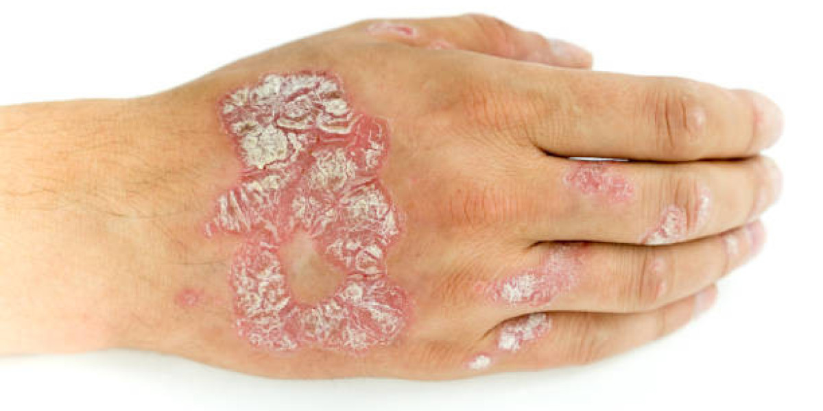 What Are the Common Causes of Eczema in Adults?