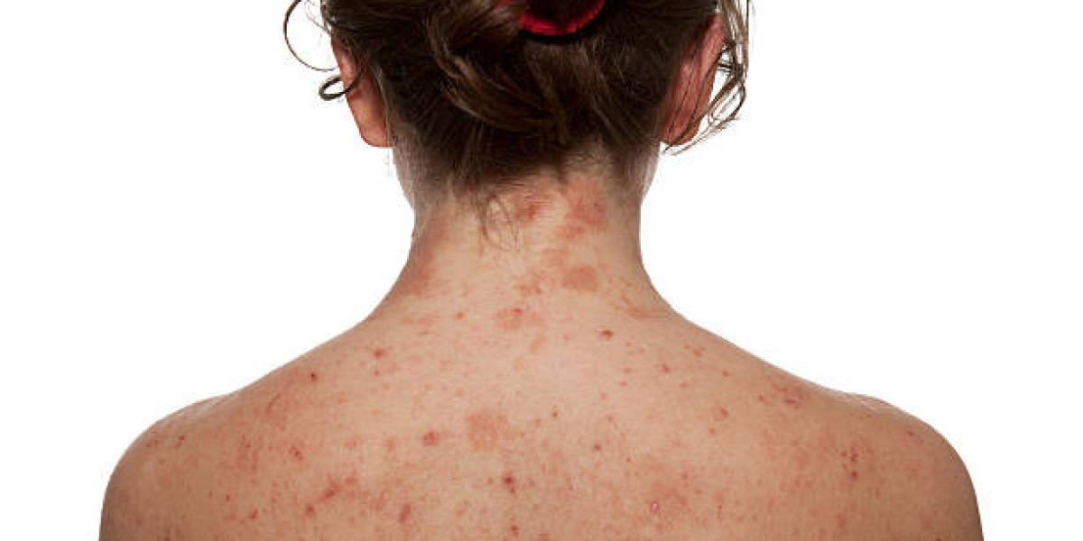 How to Treat Back Acne and Protect Healing Skin